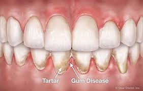 Periodontal Flap Surgery