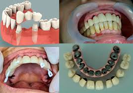 Prosthesis