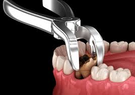 Dental Extractions