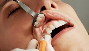 Full Mouth Disinfection