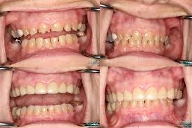 Full Mouth Rehabilitation