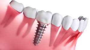 Implant Dentistry