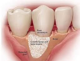 Regenerative Surgery