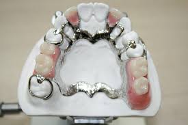 Removal Partial Dentures