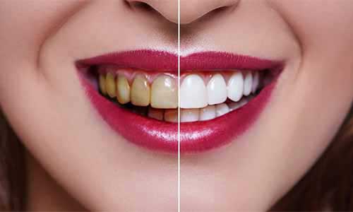 Tooth Whitening